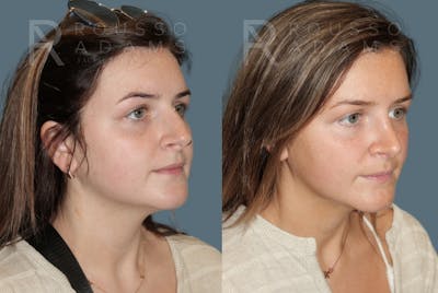 Rhinoplasty<span class=small>By Dr. Austin Adams</span> Before & After Gallery - Patient 277879 - Image 2