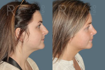 Rhinoplasty<span class=small>By Dr. Austin Adams</span> Before & After Gallery - Patient 277879 - Image 1