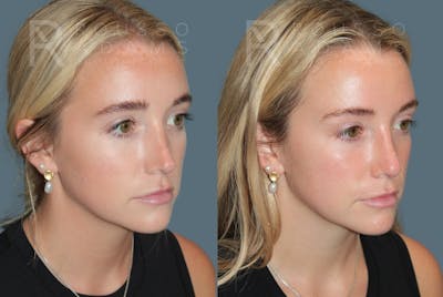 Revision Rhinoplasty<span class=small>By Dr. Austin Adams</span> Before & After Gallery - Patient 317629 - Image 2