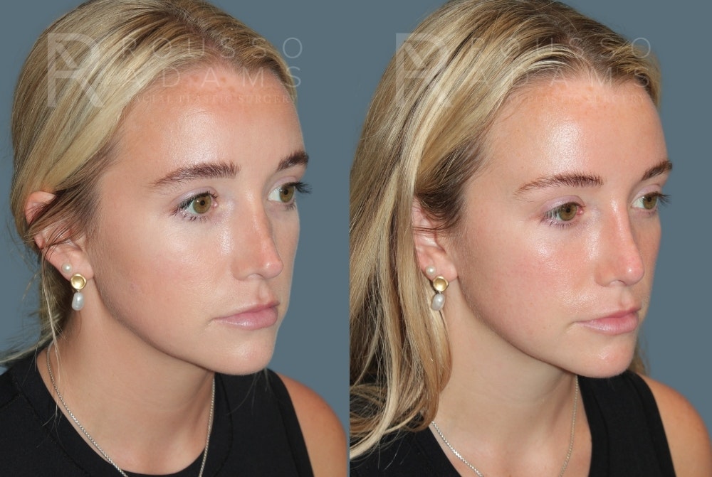 Revision Rhinoplasty<span class=small>By Dr. Austin Adams</span> Before & After Gallery - Patient 317629 - Image 2