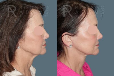 Deep Plane Facelift <span class=small>By Dr. Austin Adams</span> Before & After Gallery - Patient 147909 - Image 2