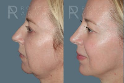 Facial Implants <span class=small>By Dr. Daniel Rousso</span> Before & After Gallery - Patient 318215 - Image 1