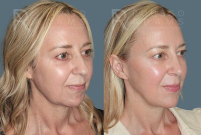 MiniLift <span class=small>By Dr. Daniel Rousso</span> Before & After Gallery - Patient 113018 - Image 2