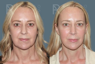 MiniLift <span class=small>By Dr. Daniel Rousso</span> Before & After Gallery - Patient 113018 - Image 1