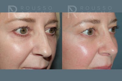 MiniLift <span class=small>By Dr. Daniel Rousso</span> Before & After Gallery - Patient 113018 - Image 6