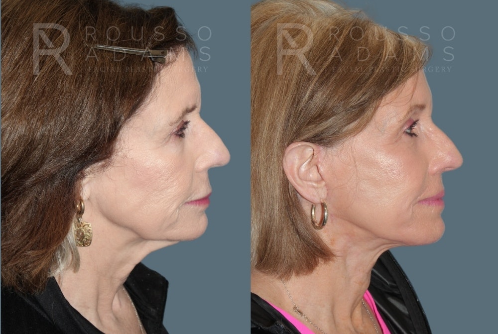 Facelift <span class=small>By Dr. Daniel Rousso</span> Before & After Gallery - Patient 428658 - Image 4