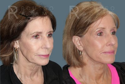 Facelift <span class=small>By Dr. Daniel Rousso</span> Before & After Gallery - Patient 428658 - Image 1
