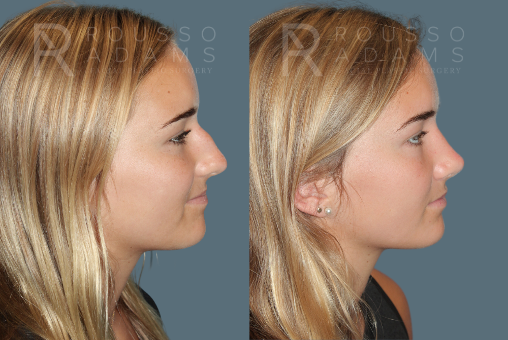 Rhinoplasty <span class=small>By Dr. Daniel Rousso</span> Before & After Gallery - Patient 933347 - Image 1