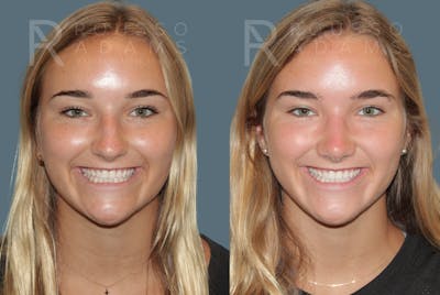 Rhinoplasty <span class=small>By Dr. Daniel Rousso</span> Before & After Gallery - Patient 933347 - Image 2