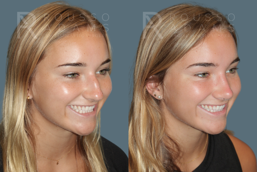 Rhinoplasty <span class=small>By Dr. Daniel Rousso</span> Before & After Gallery - Patient 933347 - Image 3