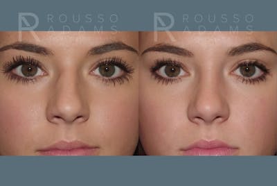 Rhinoplasty <span class=small>By Dr. Daniel Rousso</span> Before & After Gallery - Patient 357879 - Image 4