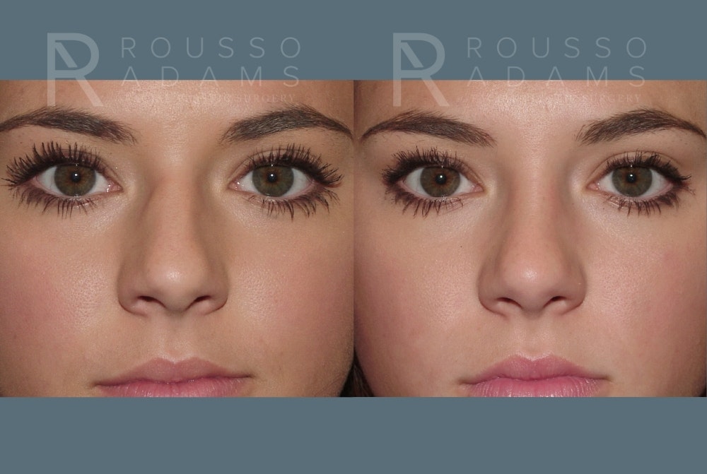 Rhinoplasty <span class=small>By Dr. Daniel Rousso</span> Before & After Gallery - Patient 357879 - Image 4