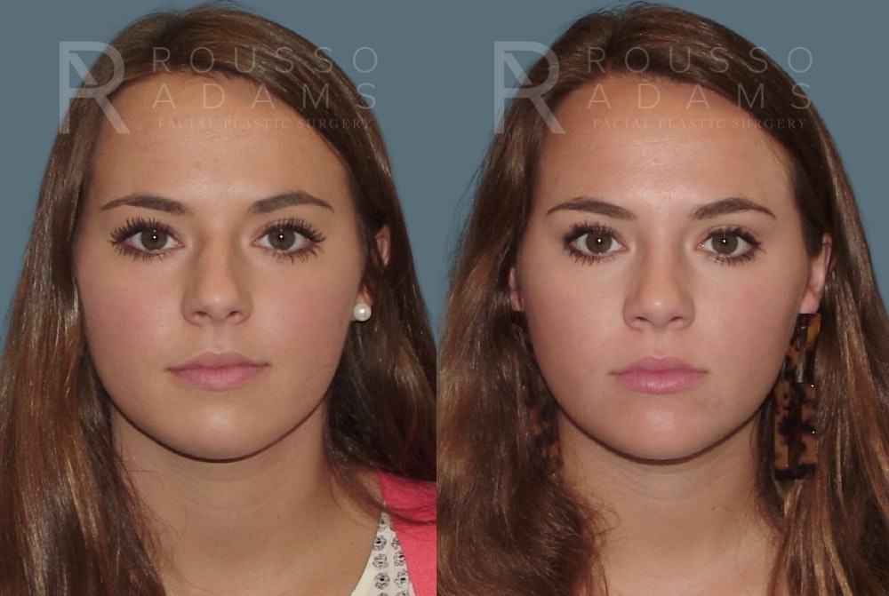 Rhinoplasty <span class=small>By Dr. Daniel Rousso</span> Before & After Gallery - Patient 357879 - Image 3