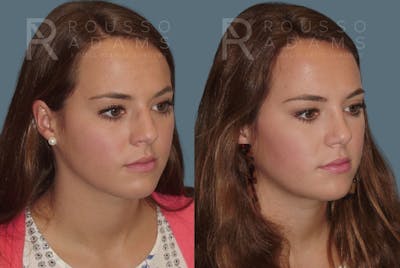 Rhinoplasty <span class=small>By Dr. Daniel Rousso</span> Before & After Gallery - Patient 357879 - Image 2