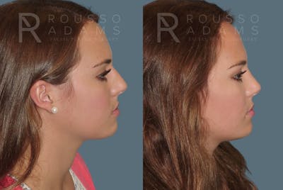 Rhinoplasty <span class=small>By Dr. Daniel Rousso</span> Before & After Gallery - Patient 357879 - Image 1