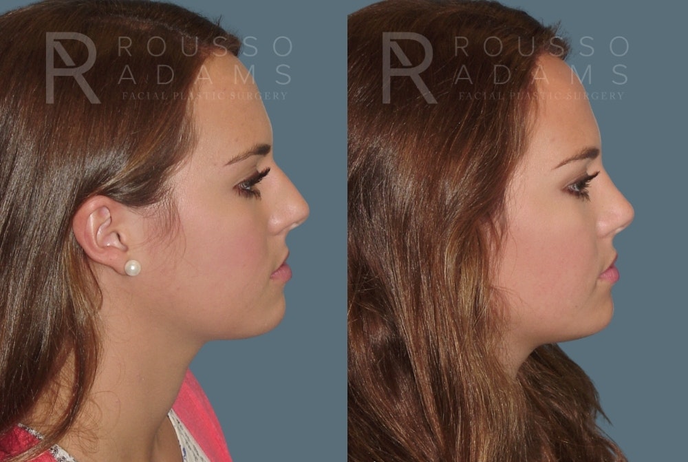 Rhinoplasty <span class=small>By Dr. Daniel Rousso</span> Before & After Gallery - Patient 357879 - Image 1