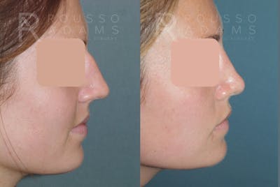 Rhinoplasty <span class=small>By Dr. Daniel Rousso</span> Before & After Gallery - Patient 249315 - Image 4
