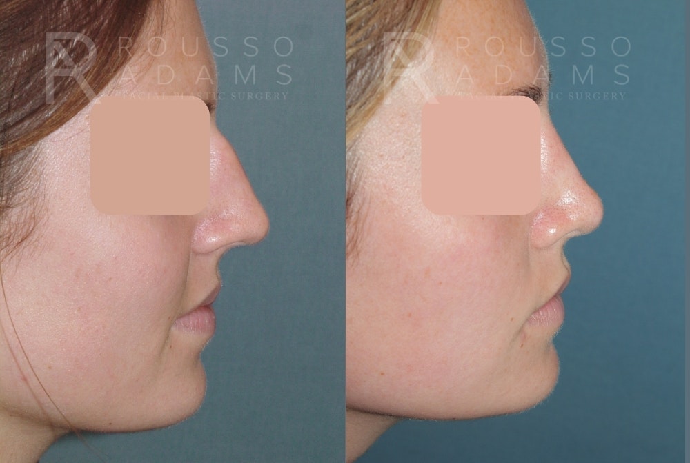 Rhinoplasty <span class=small>By Dr. Daniel Rousso</span> Before & After Gallery - Patient 249315 - Image 4