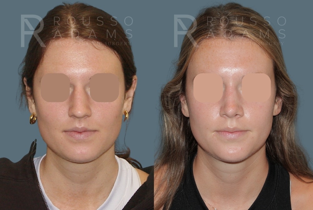 Rhinoplasty <span class=small>By Dr. Daniel Rousso</span> Before & After Gallery - Patient 249315 - Image 3