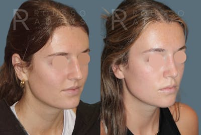 Rhinoplasty <span class=small>By Dr. Daniel Rousso</span> Before & After Gallery - Patient 249315 - Image 2