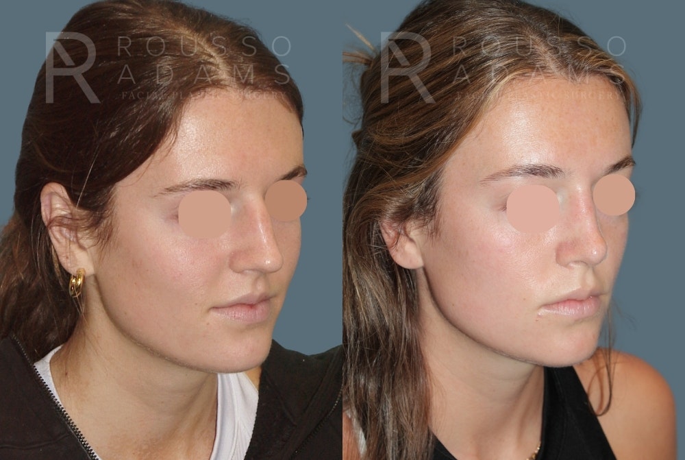 Rhinoplasty <span class=small>By Dr. Daniel Rousso</span> Before & After Gallery - Patient 249315 - Image 2