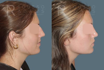 Rhinoplasty <span class=small>By Dr. Daniel Rousso</span> Before & After Gallery - Patient 249315 - Image 1