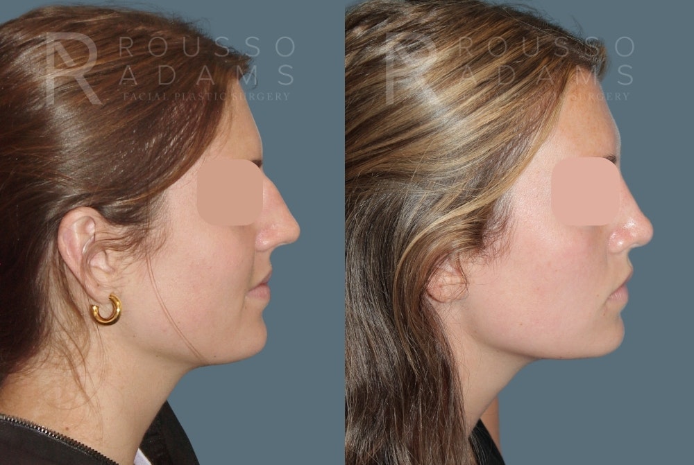 Rhinoplasty <span class=small>By Dr. Daniel Rousso</span> Before & After Gallery - Patient 249315 - Image 1