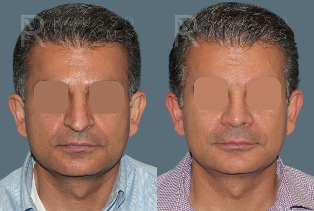 Facial Implants <span class=small>By Dr. Daniel Rousso</span> Before & After Gallery - Patient 758132 - Image 3