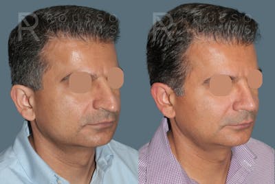 Facial Implants <span class=small>By Dr. Daniel Rousso</span> Before & After Gallery - Patient 758132 - Image 2