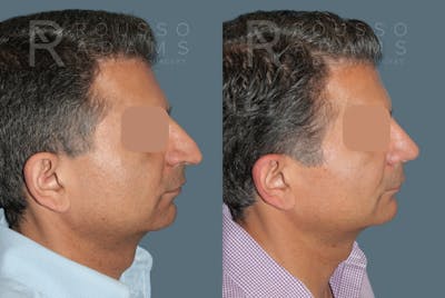 Facial Implants <span class=small>By Dr. Daniel Rousso</span> Before & After Gallery - Patient 758132 - Image 1