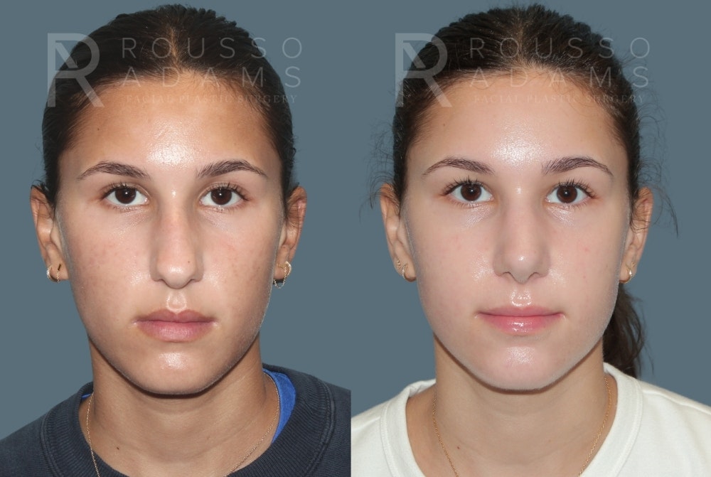Rhinoplasty <span class=small>By Dr. Daniel Rousso</span> Before & After Gallery - Patient 300386 - Image 3