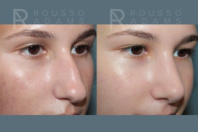 Rhinoplasty <span class=small>By Dr. Daniel Rousso</span> Before & After Gallery - Patient 300386 - Image 4