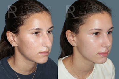 Rhinoplasty <span class=small>By Dr. Daniel Rousso</span> Before & After Gallery - Patient 300386 - Image 2