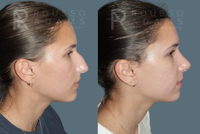 Rhinoplasty <span class=small>By Dr. Daniel Rousso</span> Before & After Gallery - Patient 300386 - Image 1