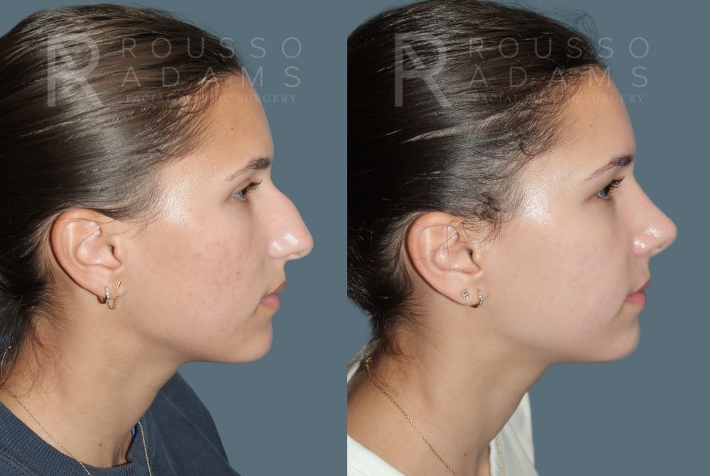Rhinoplasty <span class=small>By Dr. Daniel Rousso</span> Before & After Gallery - Patient 300386 - Image 1