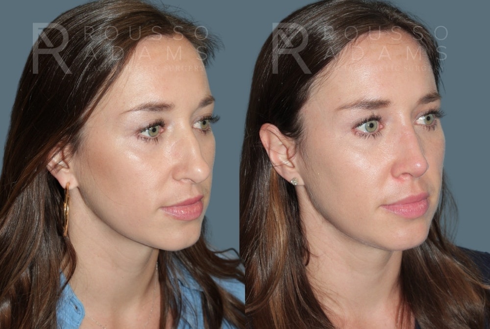 Rhinoplasty <span class=small>By Dr. Daniel Rousso</span> Before & After Gallery - Patient 399359 - Image 3