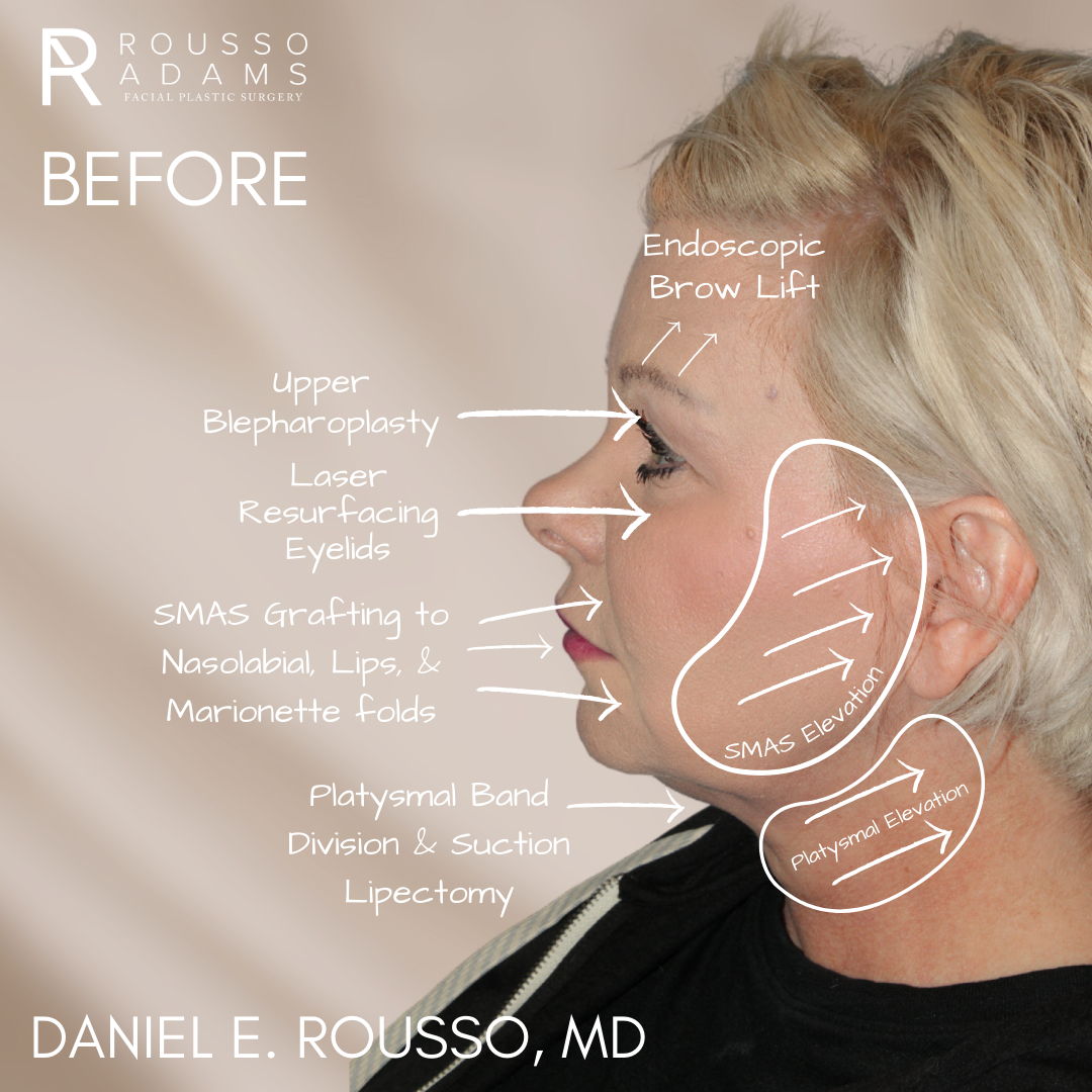before and after sculptlift 1