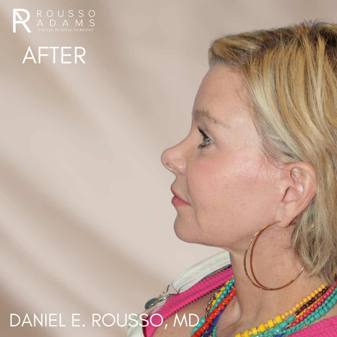 before and after sculptlift 2