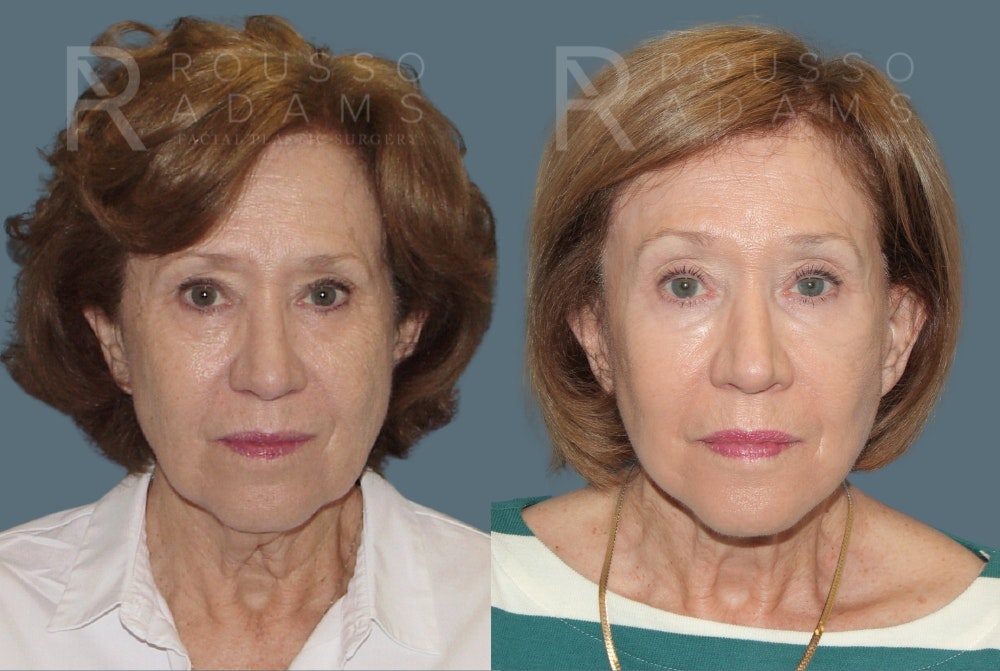 Facelift <span class=small>By Dr. Austin Adams</span> Before & After Gallery - Patient 213336 - Image 3