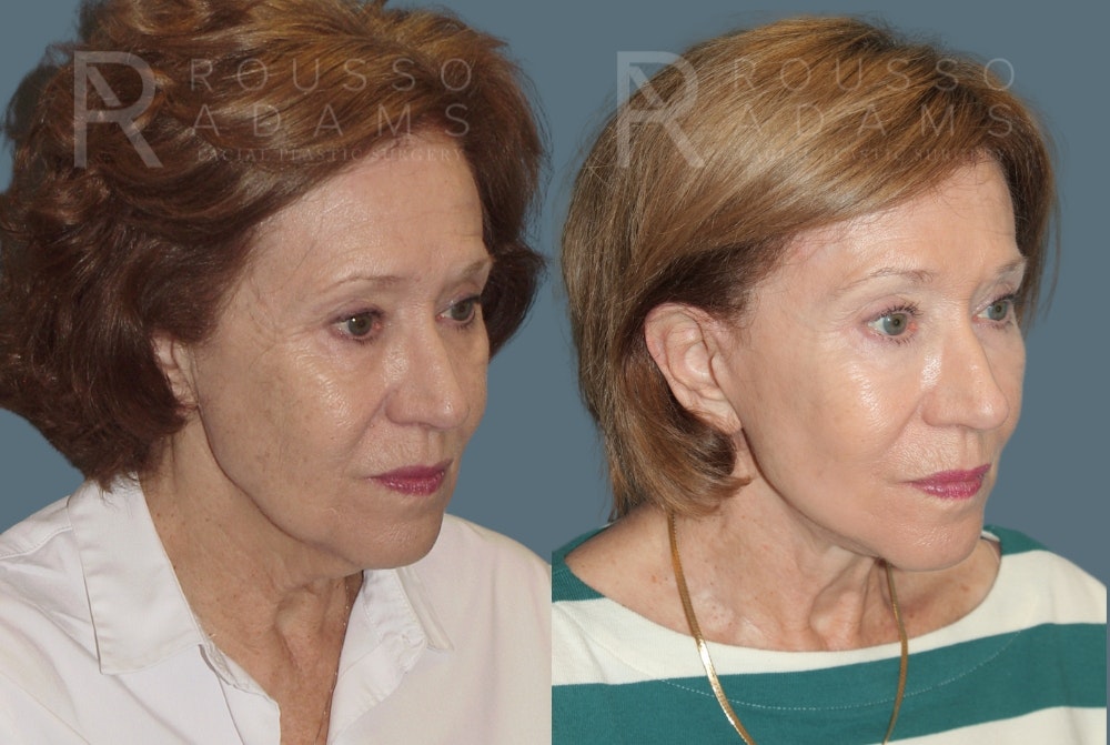 Facelift <span class=small>By Dr. Austin Adams</span> Before & After Gallery - Patient 213336 - Image 1