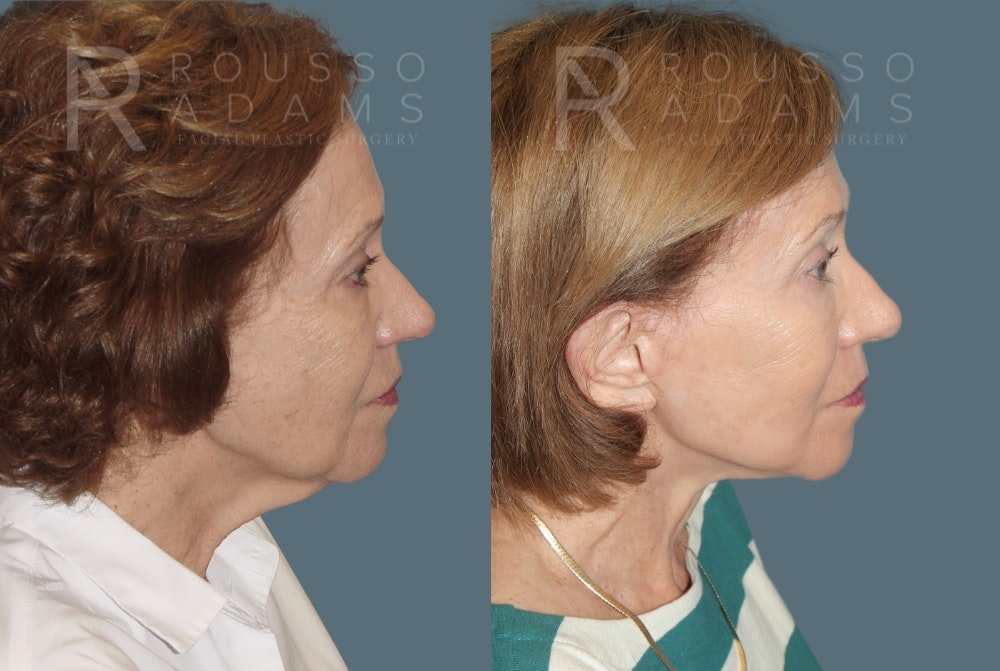 Facelift <span class=small>By Dr. Austin Adams</span> Before & After Gallery - Patient 213336 - Image 2