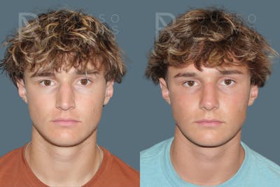 Rhinoplasty <span class=small>By Dr. Daniel Rousso</span> Before & After Gallery - Patient 259213 - Image 1