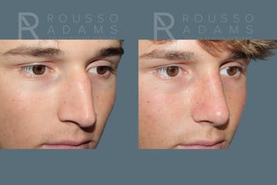Rhinoplasty <span class=small>By Dr. Daniel Rousso</span> Before & After Gallery - Patient 259213 - Image 4