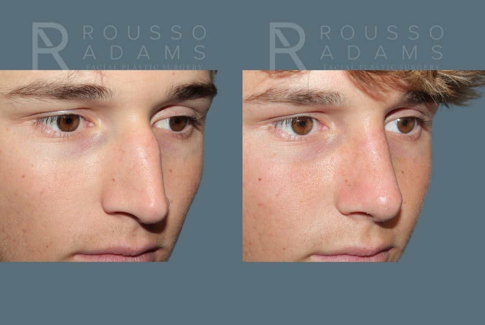 Rhinoplasty <span class=small>By Dr. Daniel Rousso</span> Before & After Gallery - Patient 259213 - Image 4
