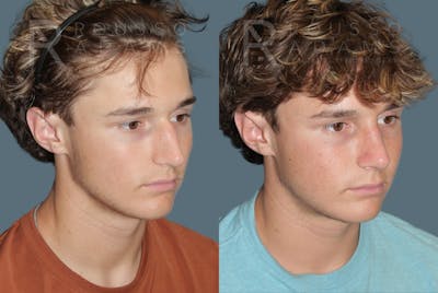 Rhinoplasty <span class=small>By Dr. Daniel Rousso</span> Before & After Gallery - Patient 259213 - Image 2