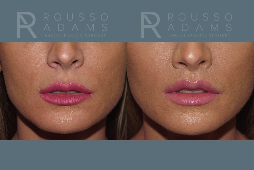 Lip Augmentation <span class=small>By Dr. Austin Adams</span> Before & After Gallery - Patient 258349 - Image 1