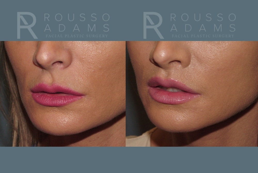 Lip Augmentation <span class=small>By Dr. Austin Adams</span> Before & After Gallery - Patient 258349 - Image 3