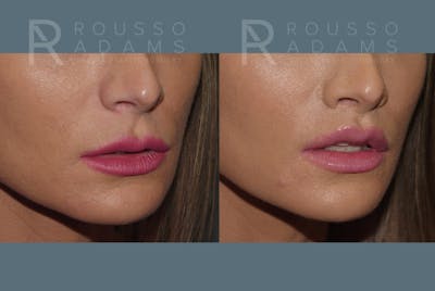 Lip Augmentation <span class=small>By Dr. Austin Adams</span> Before & After Gallery - Patient 258349 - Image 2