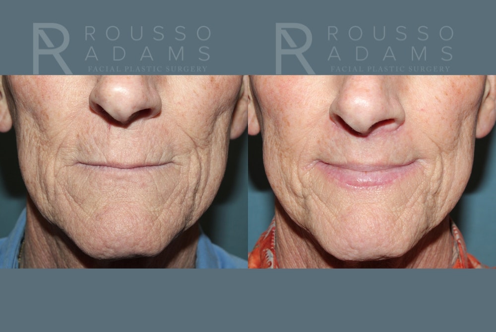 Lip Augmentation <span class=small>By Dr. Austin Adams</span> Before & After Gallery - Patient 171395 - Image 1