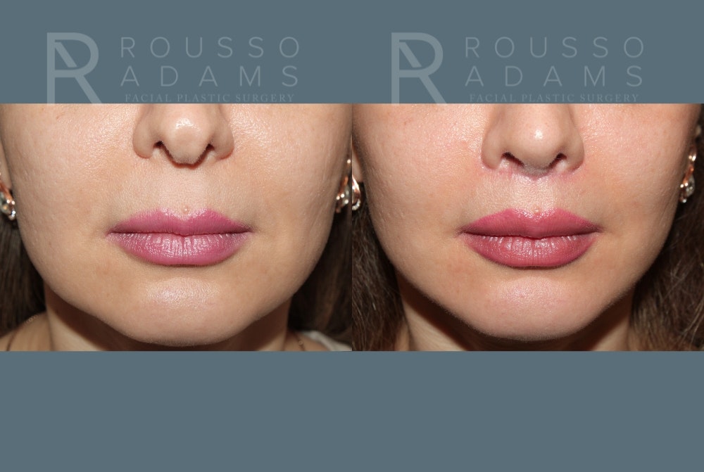 Lip Augmentation <span class=small>By Dr. Austin Adams</span> Before & After Gallery - Patient 185726 - Image 1